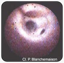Рисунок 
10.
Впадение перфорантной вены из глубины в подкожную вену в Гунтеровом
канале.