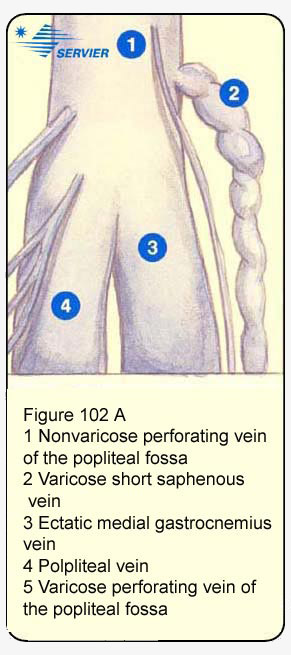 Рисунок 102А: Рецидив при вовлечении эктазированной икроножной вены