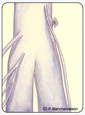 Рисунок 102: Рецидив при вовлечении эктазированной икроножной вены.