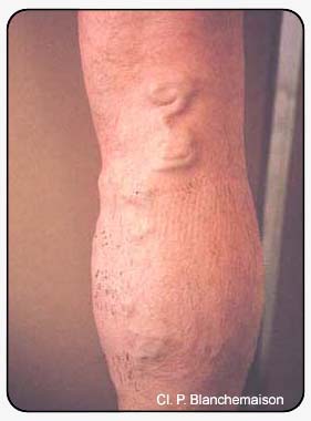 Рисунок 102: Рецидив при вовлечении эктазированной икроножной вены