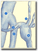 Рисунок 20. H - образное
соустье (латерально-наружный вид), тип 1.