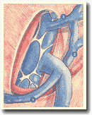 Рисунок 24. Прямой 
дренаж в бедренную вену