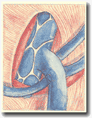 Рисунок 25. Дренаж 
в сафенофеморальный угол.