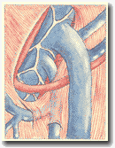 Рисунок 26. Прямой дренаж из добавочной
подкожной вены.