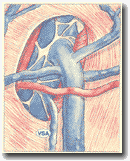 Рисунок 32. Добавочная
подкожная вена (ASV). Анастомоз с бедренной веной ниже дуги БПВ.