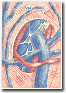 Рисунок 33: Добавочная
подкожная вена (ASV). Анастомоз с бедренной веной далеко от дуги БПВ.