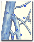 Рисунок 
41:
Анатомические и гемодинамические причины рецидивов хирургического лечения в паху;
 (причины обозначены в тексте).