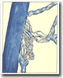 Рисунок 
43: Неоваскулогенез (кавернома).