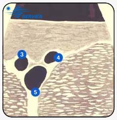 Паховый
регион - Ультразвуковая картина