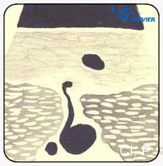 Перфорантные вены приводящего
канала (Перфоранты Додда). Анатомические варианты
и ультрасонографические корреляции.