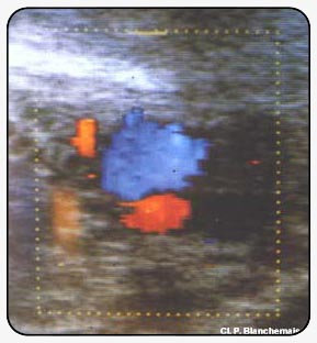 Рисунок 7. Ультрасонография-цветовой
допплер. Наложение поверхностной бедренной вены и артерии, некомпетентность добавочной
подкожной вены.