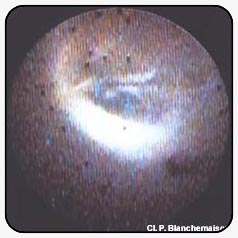 Здоровый, функционирующий
клапан подкожной вены