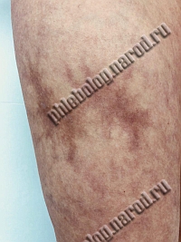 некроз после микросклеротерапии