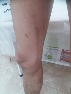 пигментация после ЭВЛК