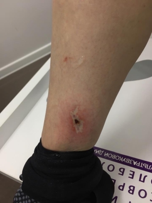 некроз после склеротерапии