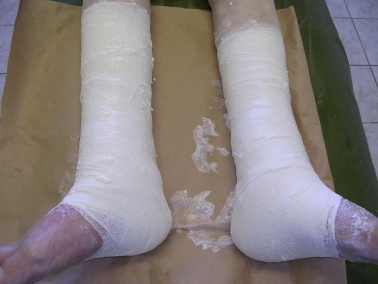 повязка Унна