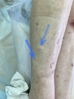 Пьезогенная грыжа