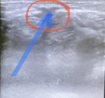 Пьезогенная грыжа