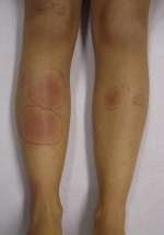 Узловатая эритема