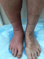 Рожистое воспаление