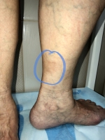 Склеродермия