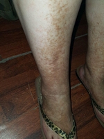 Болезнь Шамберга