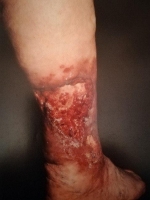 Язва при васкулите