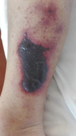 Варфариновый некроз