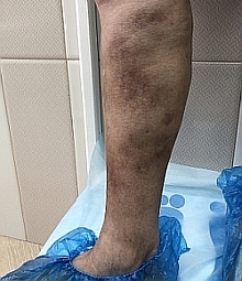 пигментация после минифлебэктомии