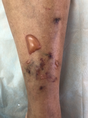 компрессионные пузыри