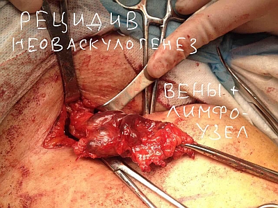 неоваскулогенез