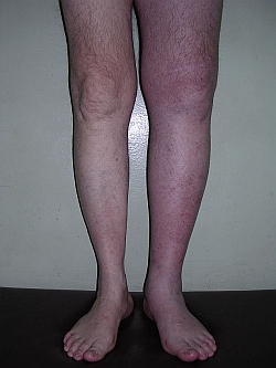 тромбоз глубоких вен