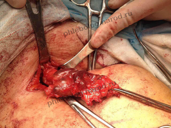 Оперировать рецидив варикоза