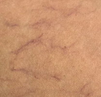 телеангиэктазии