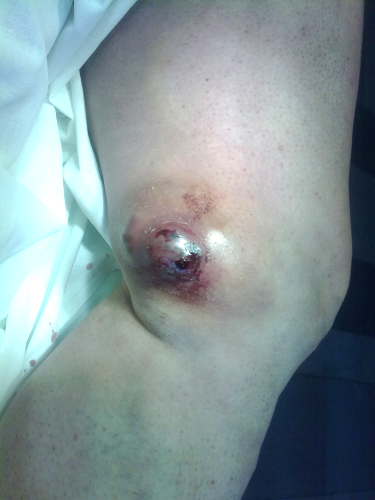 тромбофлебит