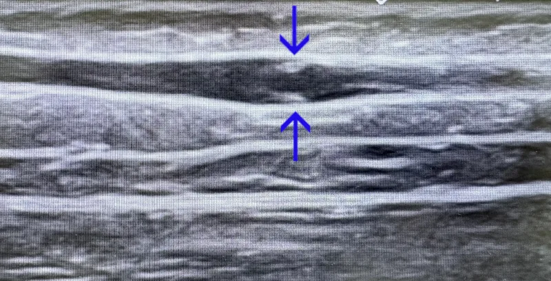 венозный клапан