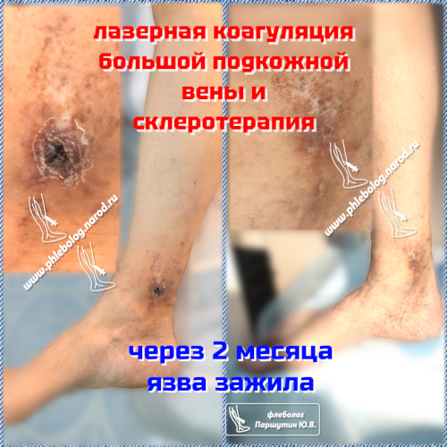 лечим поэтапно