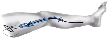 инвагинационный стриппинг