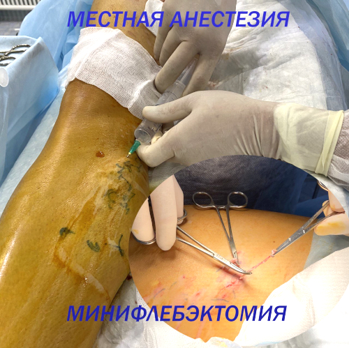 операция минифлебэктомия