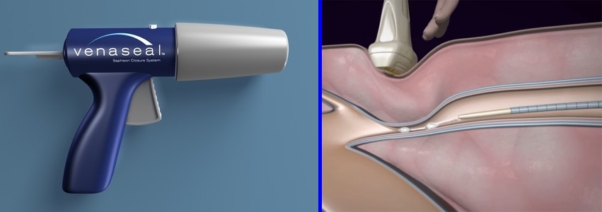 VenaSeal