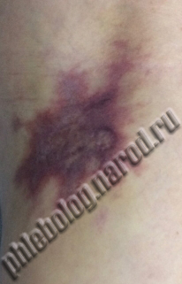 некроз после склеротерапии