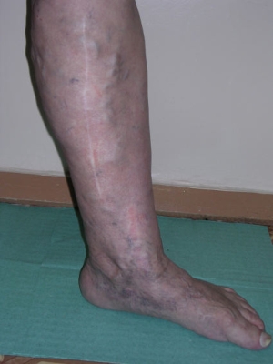 рецидив варикоза