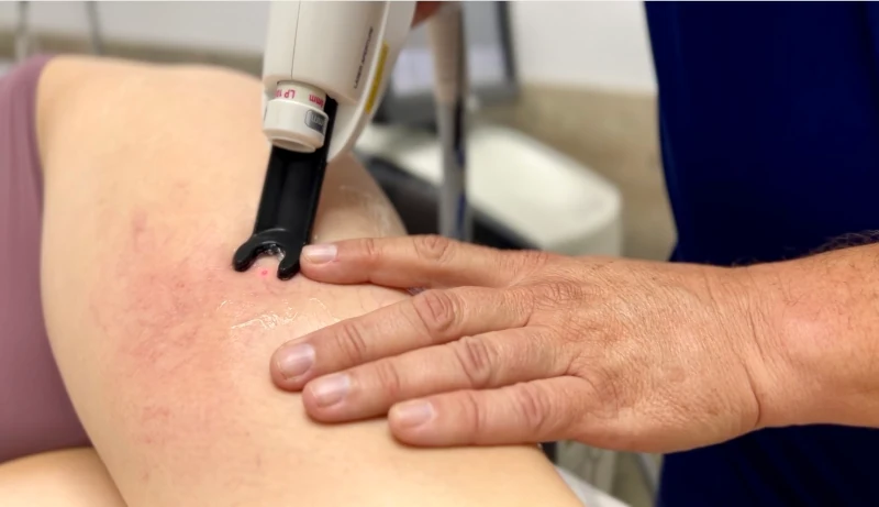 лазерная коагуляции сосудистых звездочек