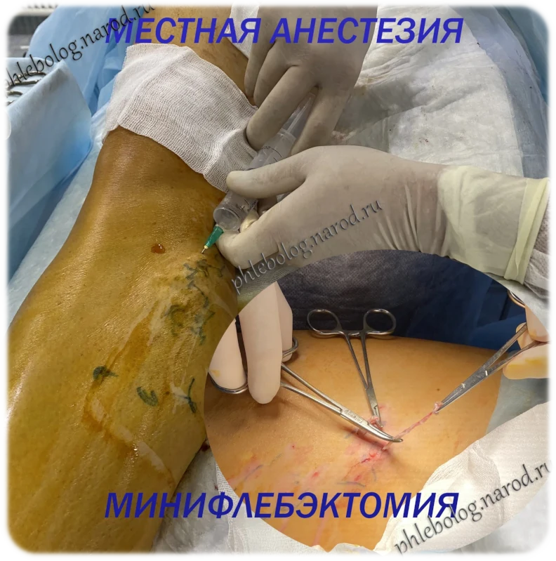 Минифлебэктомия
