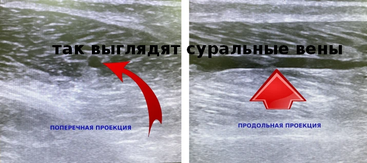 суральная вена на узи