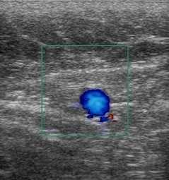 цветное картирование БПВ