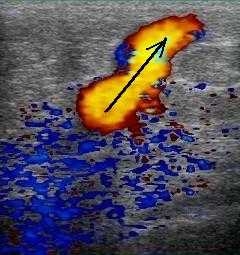 рефлюкс при цветном картировании