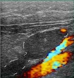 суральные вены