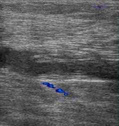 тромбоз суральной вены