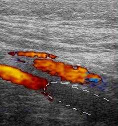 тромбоз подколенной вены